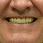 full mouth reconstruction golden co after
