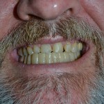 full mouth reconstruction golden co before