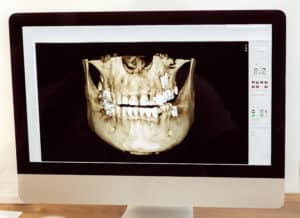 computer showing 3 d imaging of someone's bones in and around their mouth