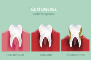Gum Disease Golden CO | Gingivitis Denver