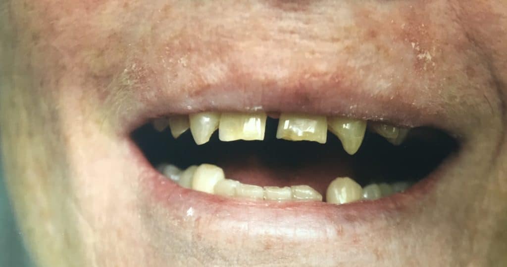 close up of man's mouth with severely disfigured teeth