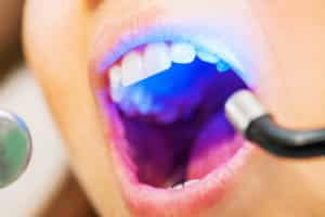 Laser Dentistry Golden CO