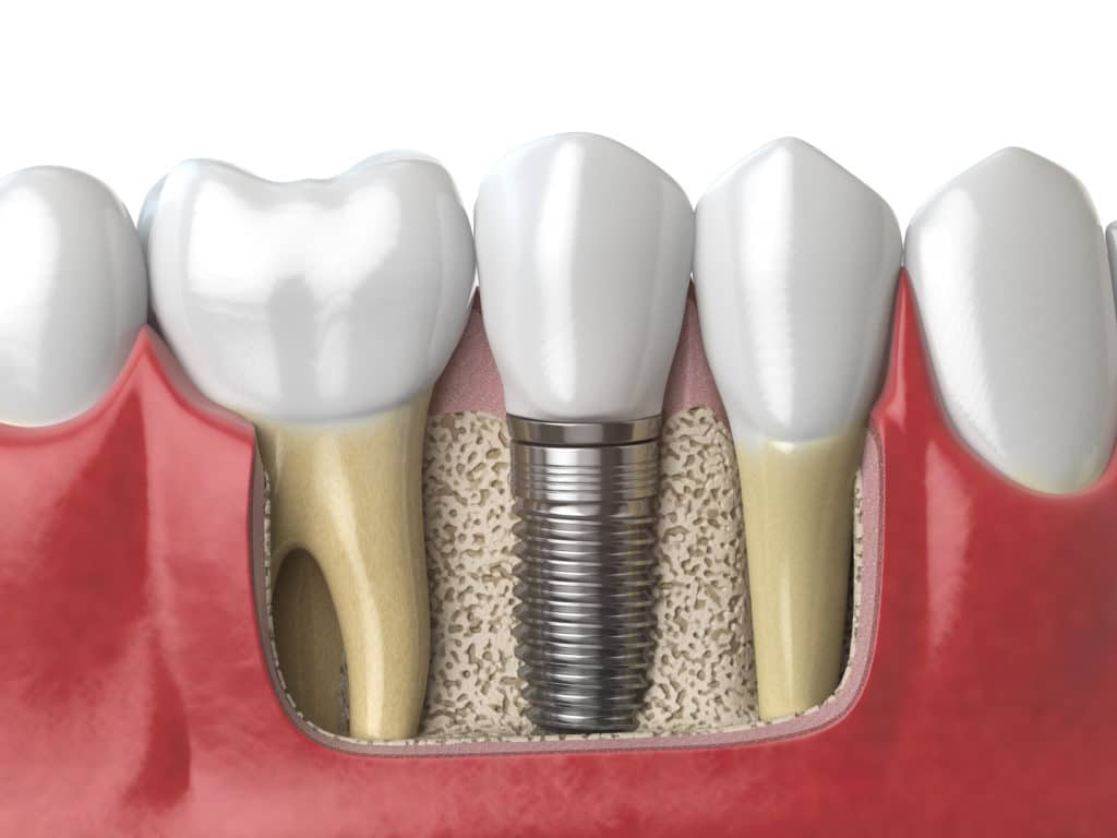 Dental Implants Golden CO