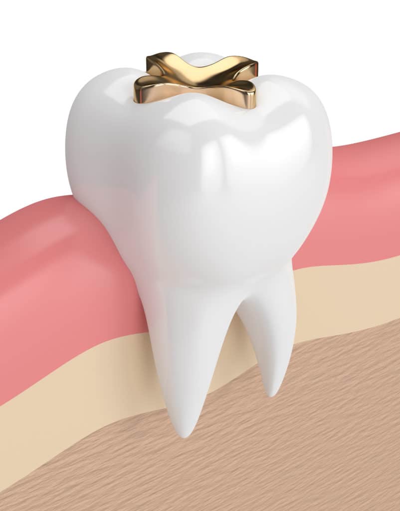 Dental Inlay Golden, CO