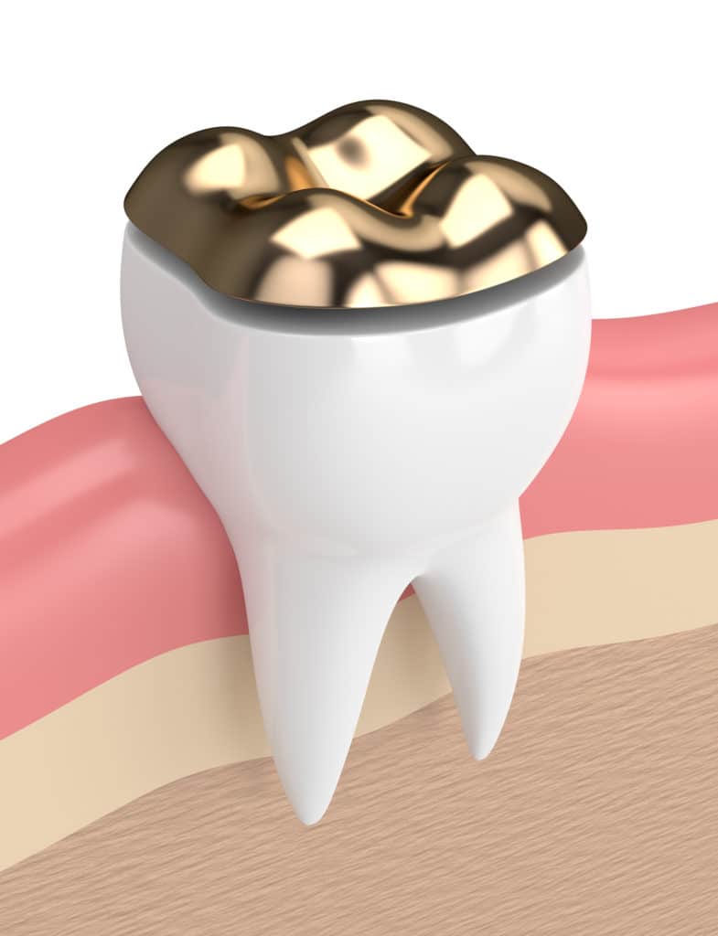 Dental Onlay Golden, CO