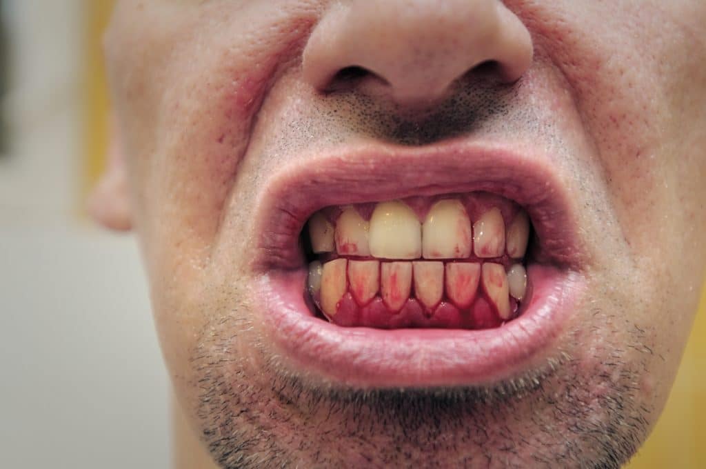 Man with bleeding gums