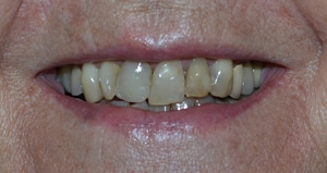 picture of slightly crooked and discolored teeth
