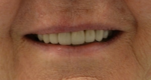 picture of teeth after receiving perfect procelain veneers