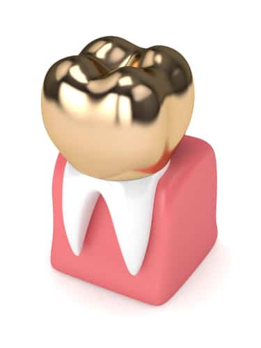 3D render of a dental crown