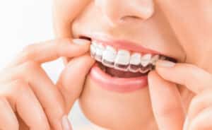 Woman,Wearing,Orthodontic,Silicone,Trainer.,Invisible,Braces,Aligner.,Mobile,Orthodontic