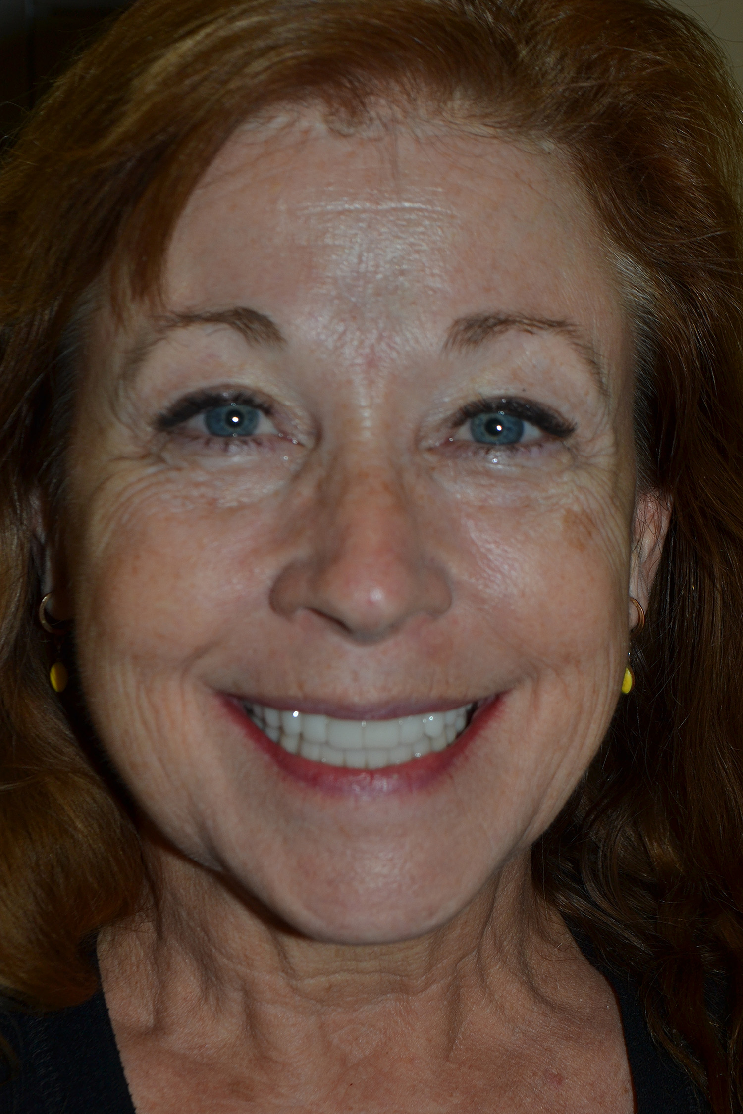 After Image: Full Mouth Restoration - front