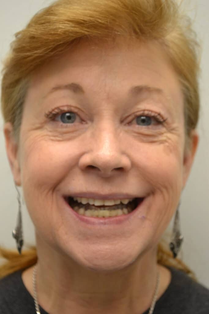 Before Image: Full Mouth Restoration - front