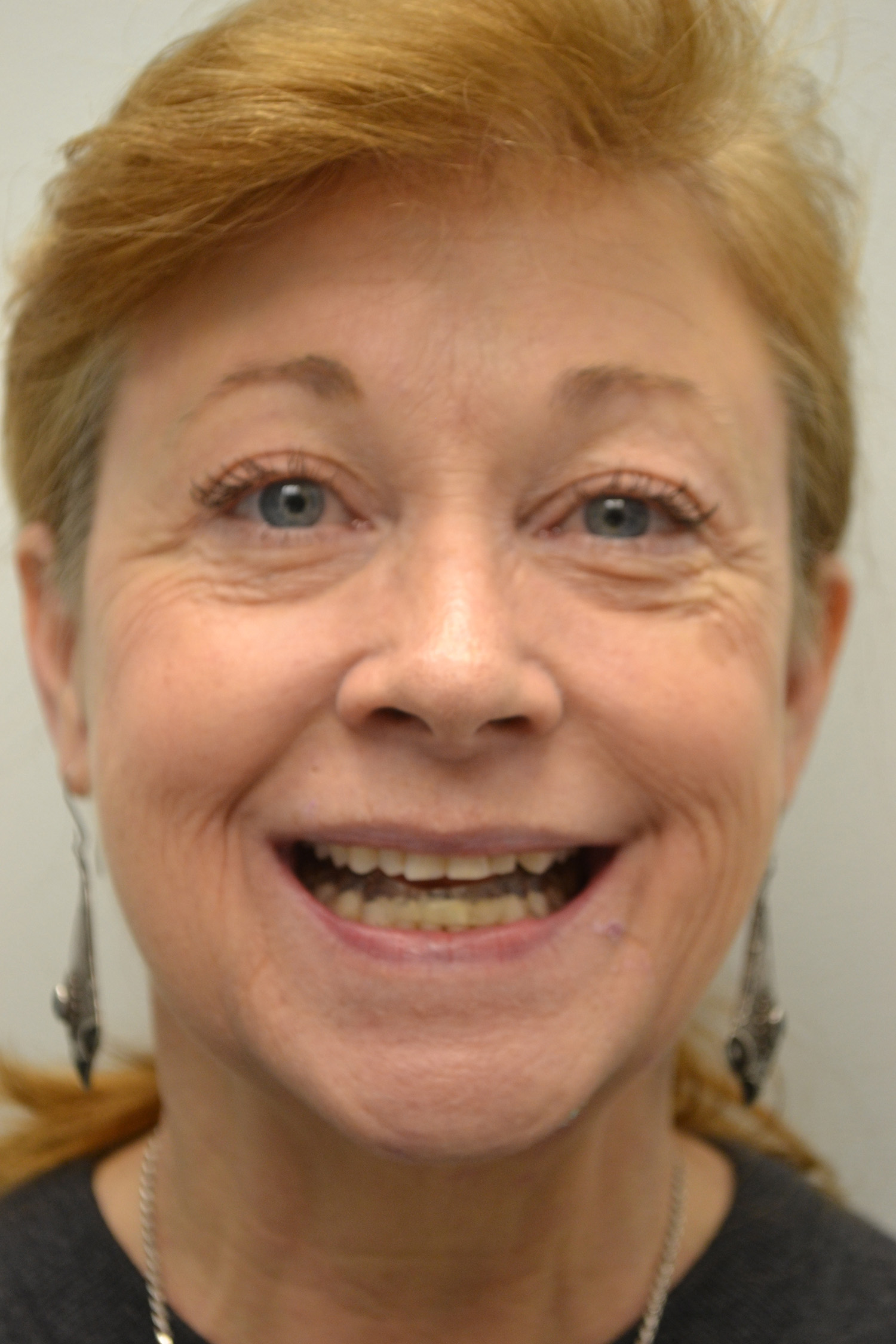 Before Image: Full Mouth Restoration - front