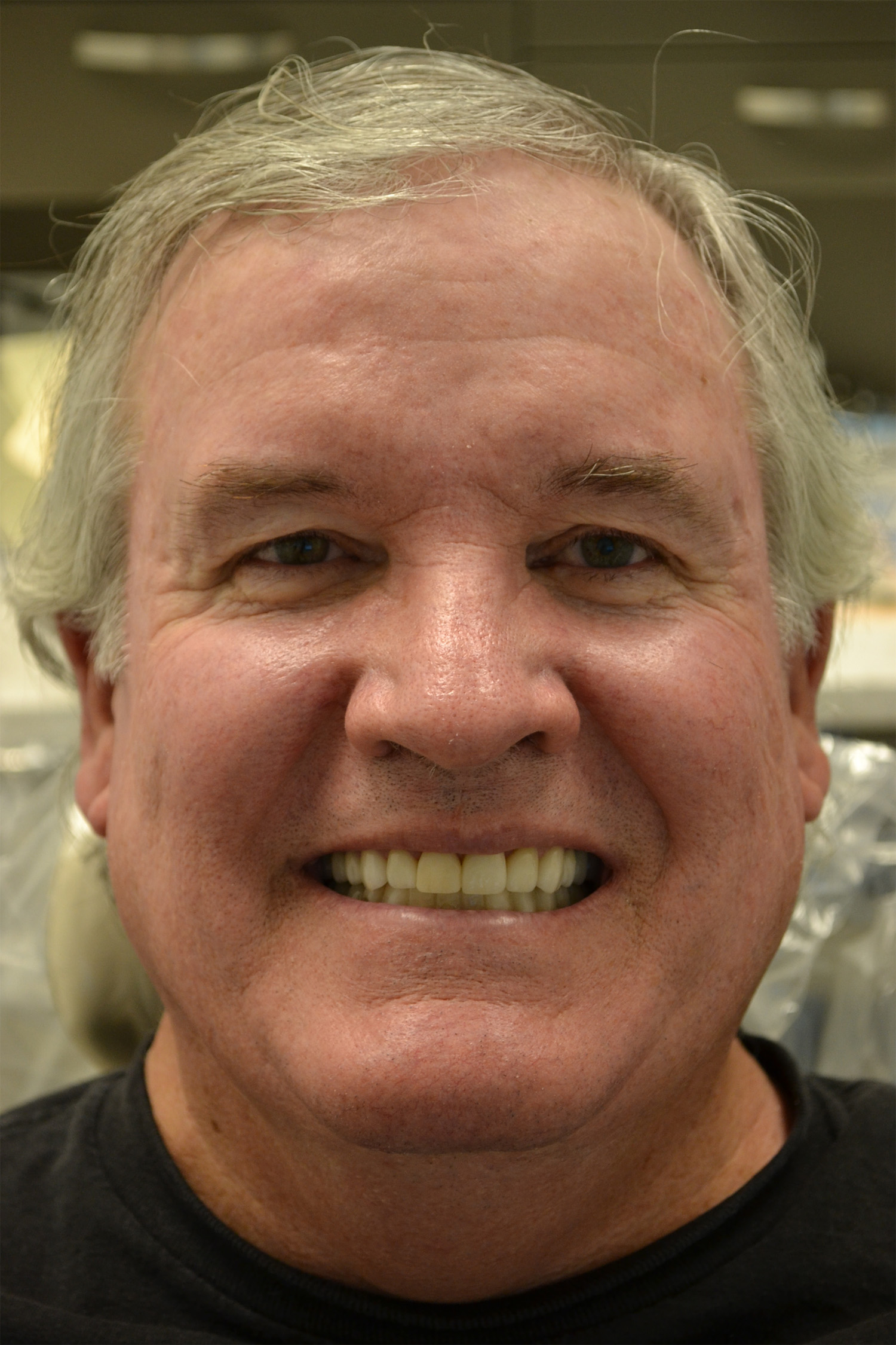 After Image: Full Mouth Restoration - front