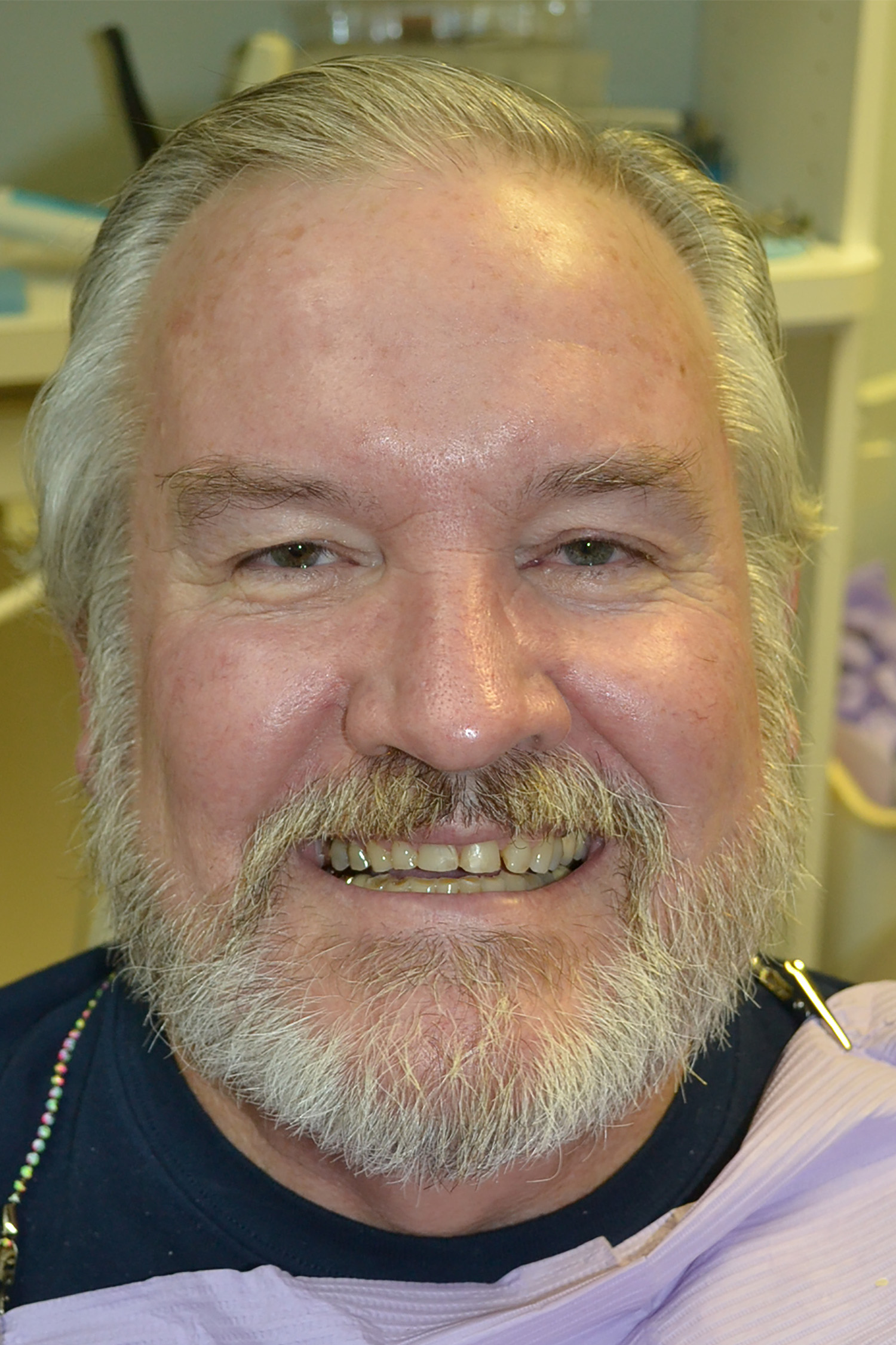 Before Image: Full Mouth Restoration - front