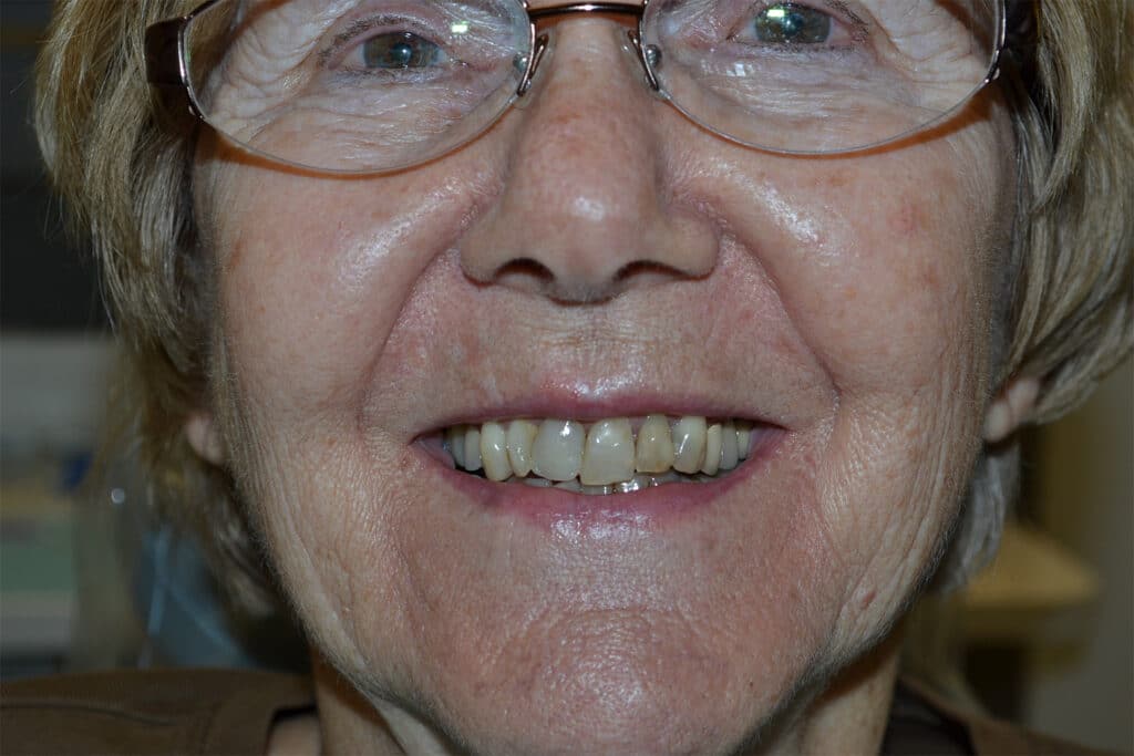 Before Image: Full Mouth Restoration - front
