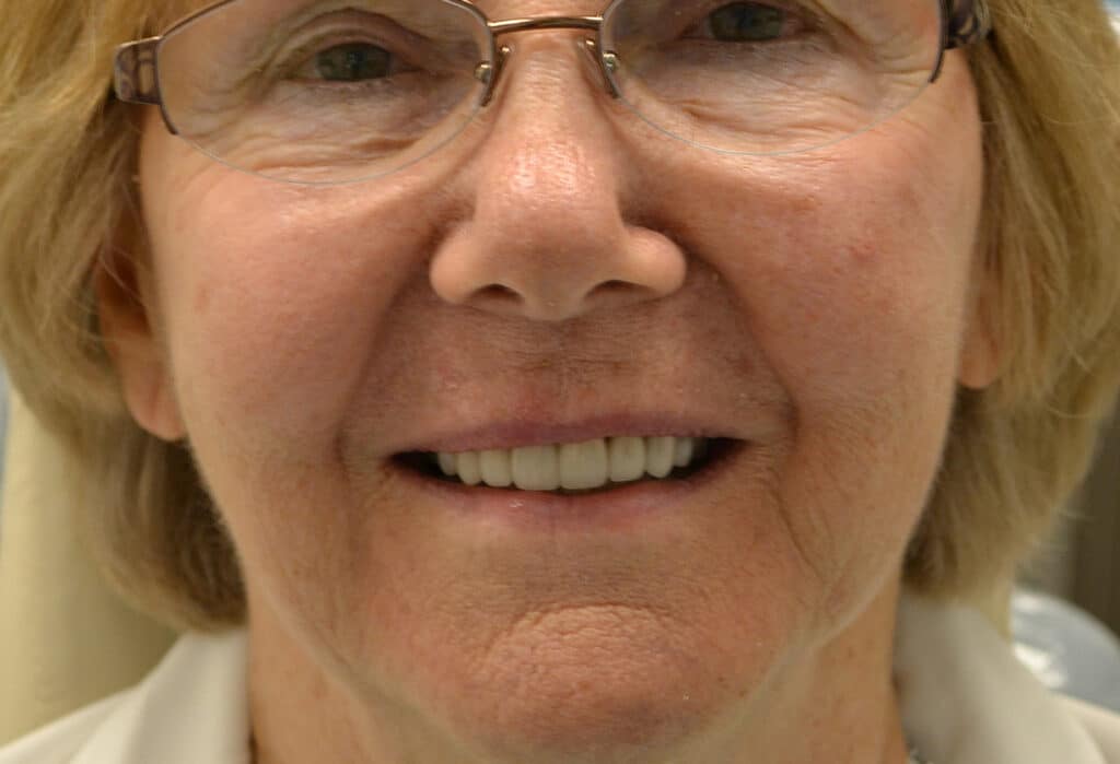 After Image: Full Mouth Restoration - front
