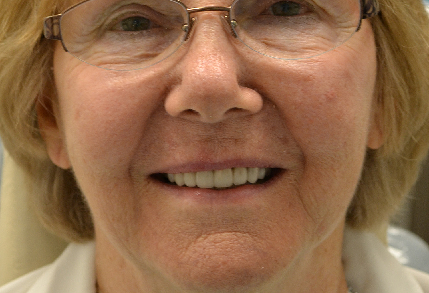 After Image: Full Mouth Restoration - front