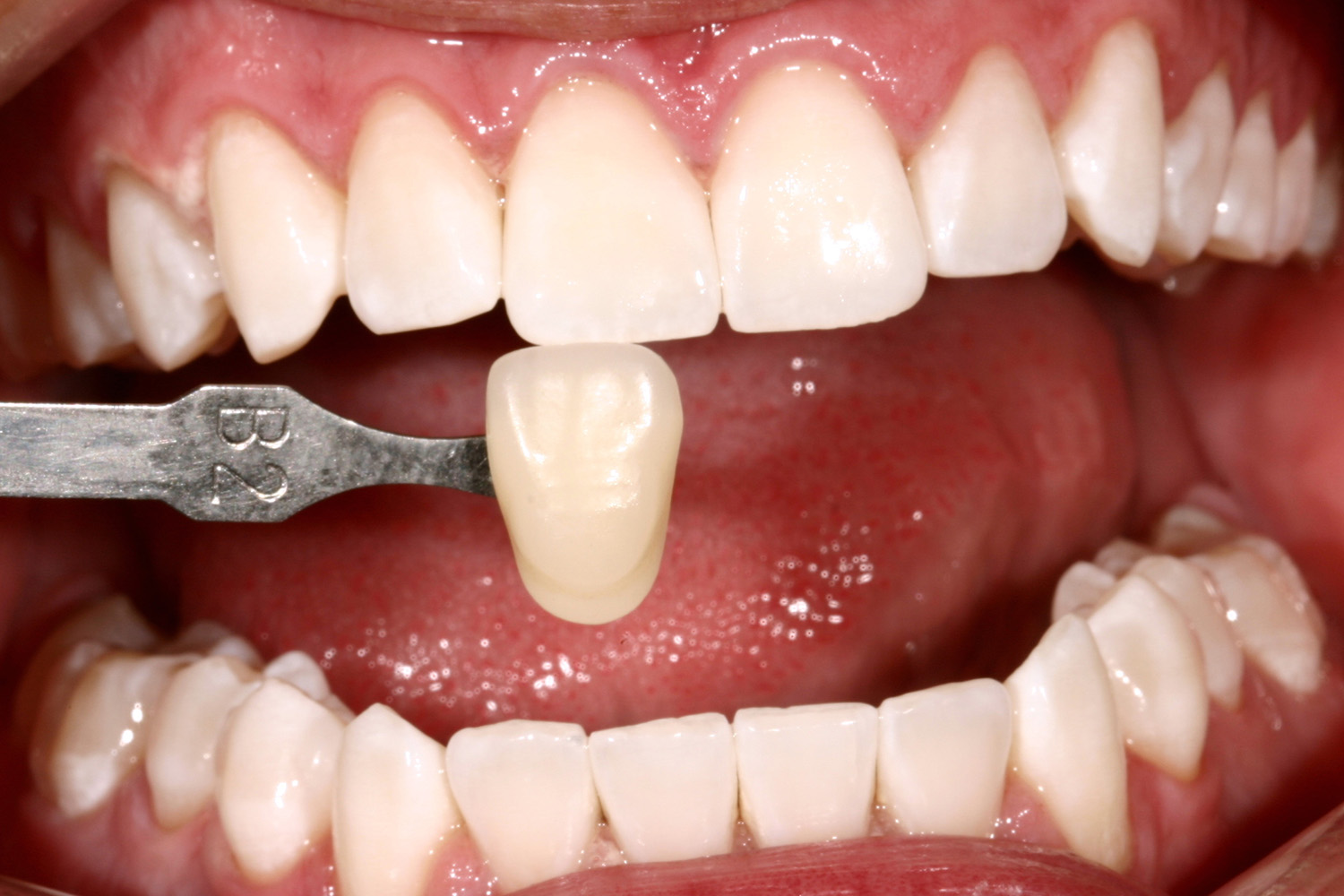 After Image: Kor Teeth Whitening - front