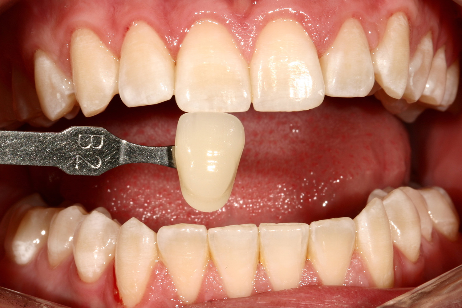Before Image: Kor Teeth Whitening - front