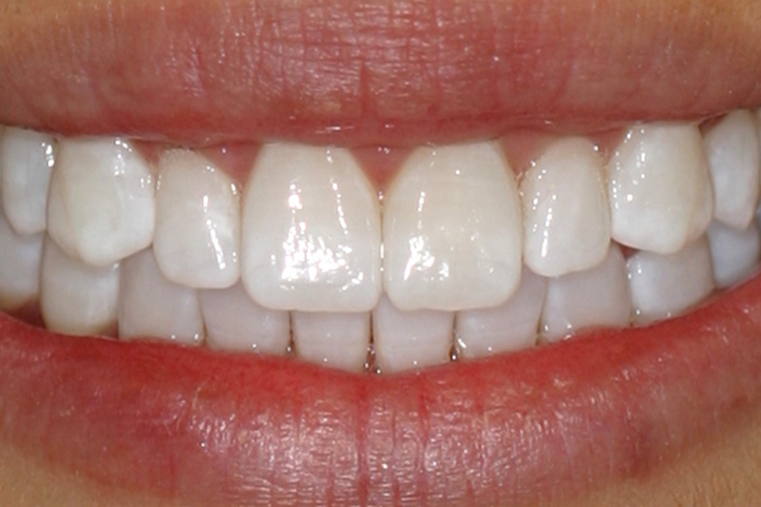 After Image: Kor Teeth Whitening - front