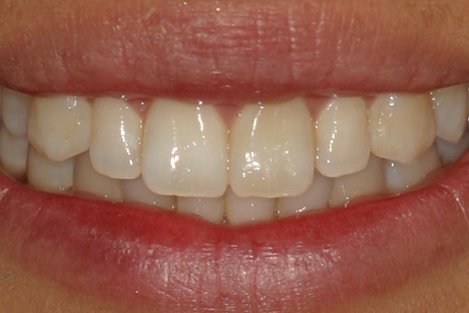 Before Image: Kor Teeth Whitening - front