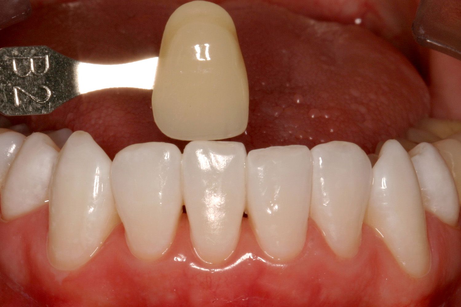 After Image: Kor Teeth Whitening - front
