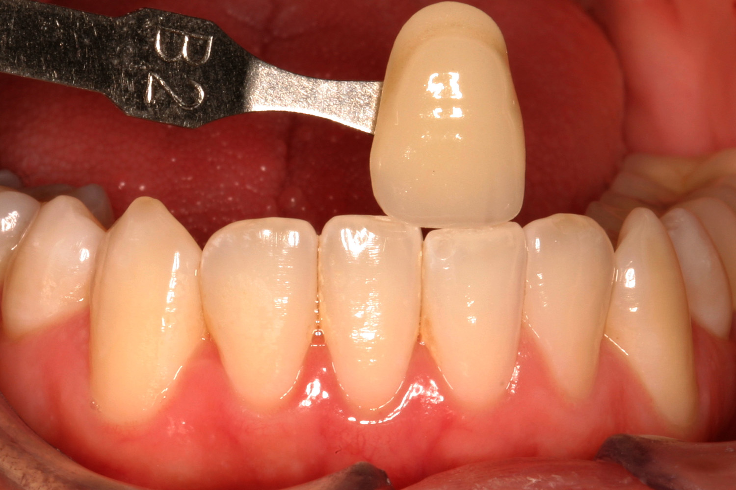 Before Image: Kor Teeth Whitening - front