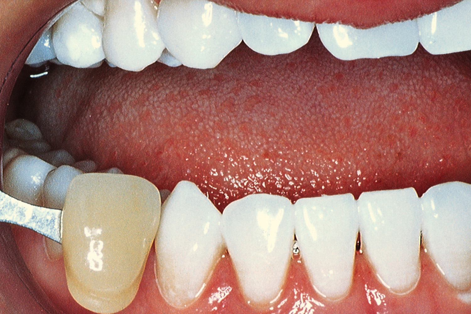 After Image: Kor Teeth Whitening - right-front-oblique