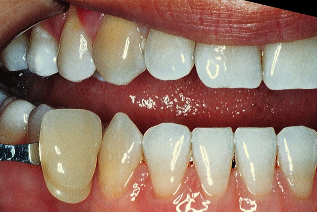 Before Image: Kor Teeth Whitening - right-front-oblique
