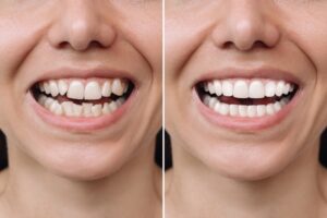 Before and after photos show woman showing her teeth with and without veneers.