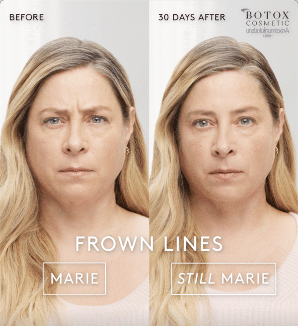 Botox in Golden CO Before and After Botox Golden CO