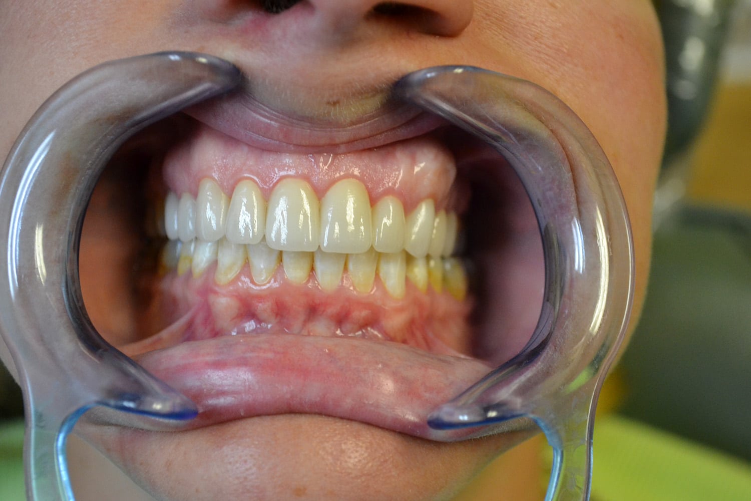 After Image: Full Mouth Restoration - front
