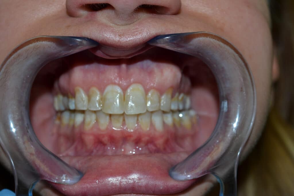 Before Image: Full Mouth Restoration - front