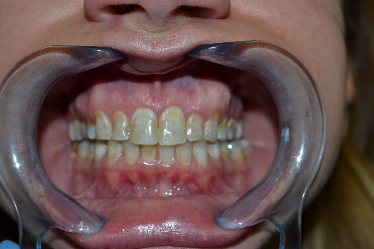 Before Image: Full Mouth Restoration - front