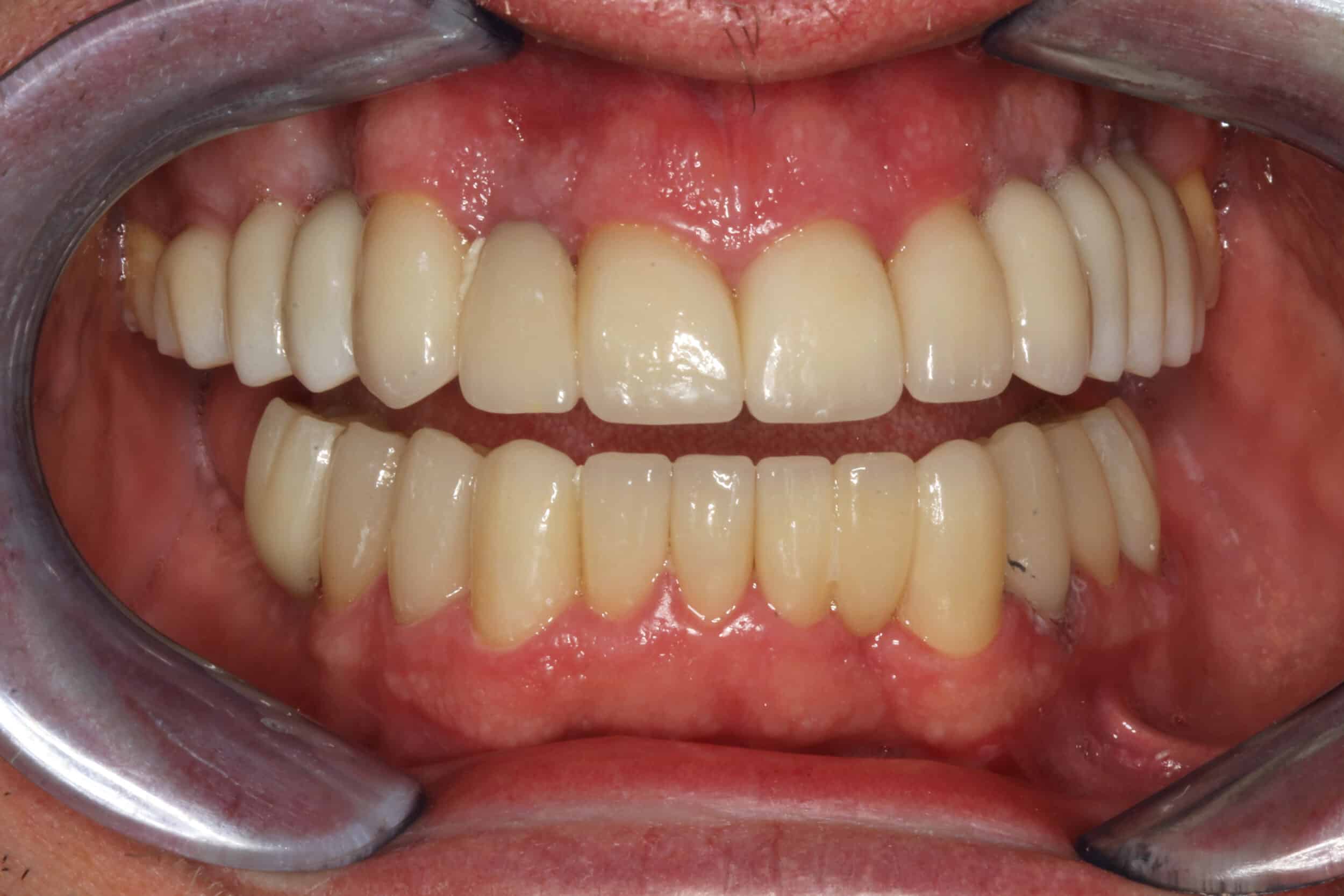 After Image: Full Mouth Restoration - front