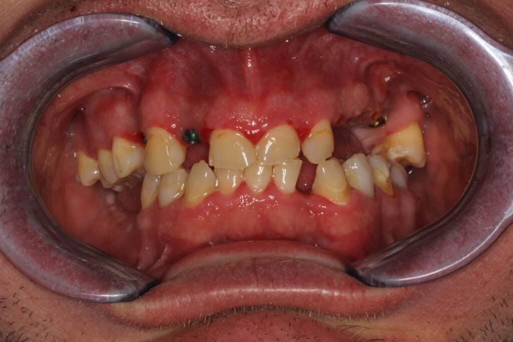 Before Image: Full Mouth Restoration - front