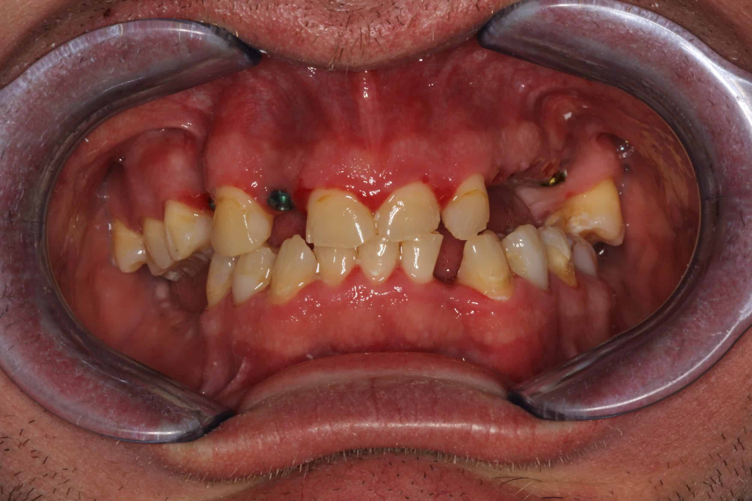 Before Image: Full Mouth Restoration - front
