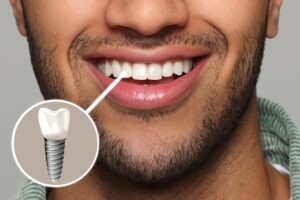 Man has attractive smile after replacing tooth with dental implant.