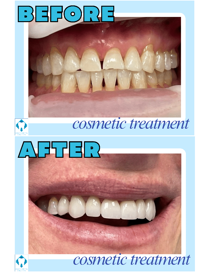 Porcelain Dental Veneers in Denver CO Porcelain Dental Veneers in Golden & Lakewood, CO