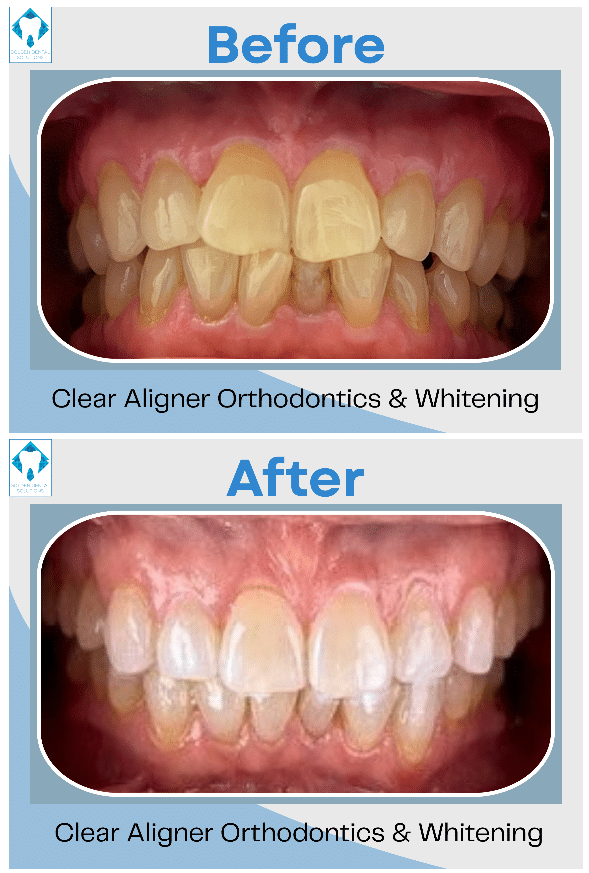 SimplyClear Aligners in Golden & Lakewood, CO
