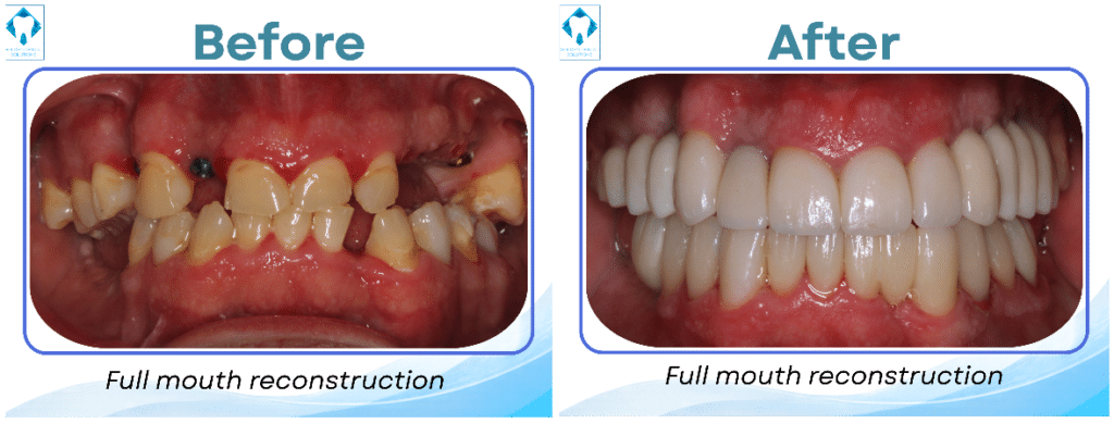 Full Mouth Rehabilitation in Golden & Lakewood, CO